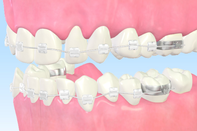 ブラケット矯正
